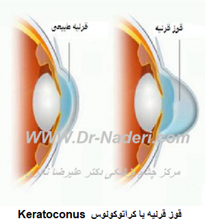  قوز قرنیه یا کراتو کونوس چیست؟:Keratoconus قوز قرنیه یا کراتوکونوس